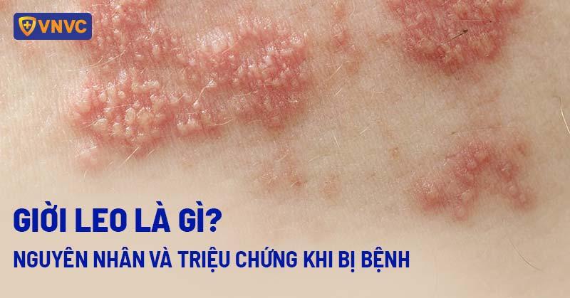 Hình ảnh con giời leo xuất hiện trên vùng mặt, quanh mắt hoặc trong khoang miệng gây đau đớn và biến chứng nguy hiểm