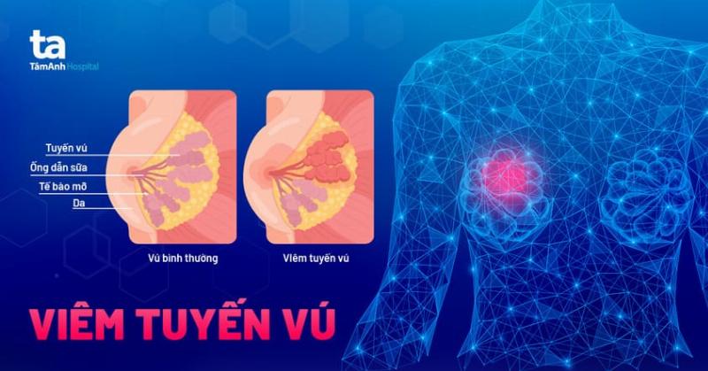 Hình ảnh viêm tuyến vú thể hiện vùng vú bị sưng đỏ do viêm nhiễm vi khuẩn