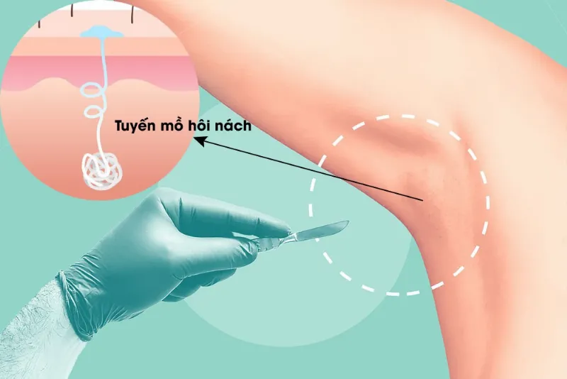 Trả lời câu hỏi về cảm giác đau khi trị hôi nách bằng laser và cảm giác sau thủ thuật.