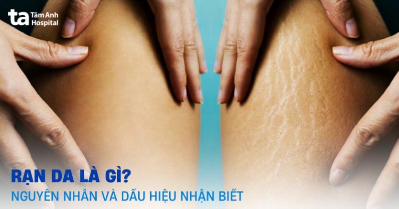 Cách Trị Rạn Đỏ Nhanh Nhất: Khám Phá Lộ Trình Hiệu Quả Từ Chuyên Gia