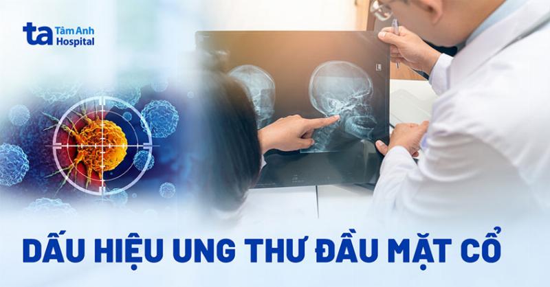 Chớm Ung Thư Vòm Họng: Dấu Hiệu Nhẹ Nhàng Dễ Bỏ Qua và Lời Khuyên Từ Chuyên Gia