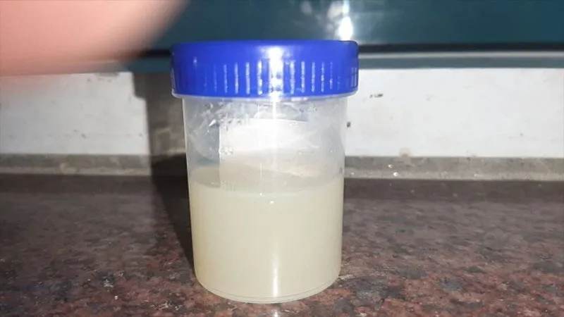 Kiến bu vào nước tiểu là dấu hiệu tiềm ẩn của bệnh tiểu đường cần được kiểm tra y tế ngay lập tức