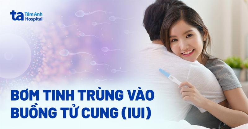 Hình ảnh minh họa kỹ thuật bơm tinh trùng vào buồng tử cung (IUI)