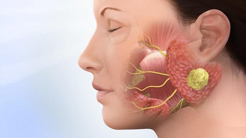Lời khuyên từ chuyên gia y tế về u tuyến nước bọt dưới hàm