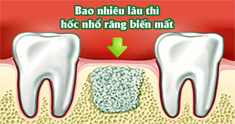 Hinh anh lo nhổ rang sau 1 tuần với mô hạt đang phát triển, lợi co lại, dấu hiệu lành thương tốt