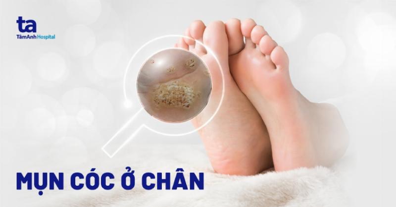 Lòng Bàn Chân Bị Nổi Cục Đau: Khi Nào Cần Cẩn Trọng?