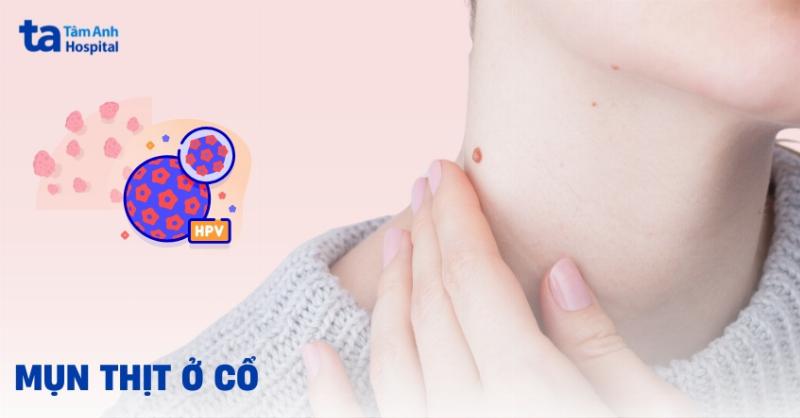 Hình ảnh mụn thịt ở cổ: Hiểu rõ để không còn lo lắng