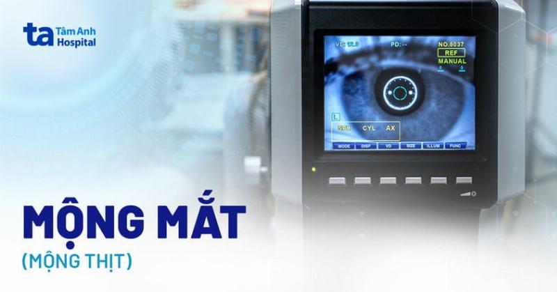 Tròng Trắng Mắt Bị Đục: Dấu Hiệu Cảnh Báo Không Thể Làm Ngơ