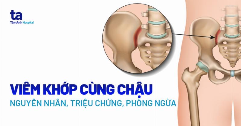 Hình ảnh Viêm Khớp Cùng Chậu: Hiểu Đúng & Đầy Đủ Nhất