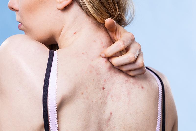 Nguyên nhân gây mụn lưng thường gặp và cách khắc phục tại nhà chi tiết