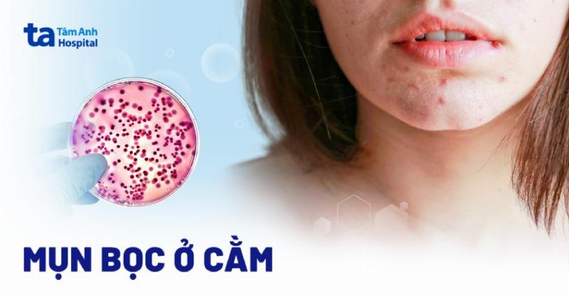Mụn Sưng To và Cứng ở Cằm: Hiểu Rõ Nguyên Nhân và Cách Xử Lý Từ Góc Nhìn Chuyên Gia