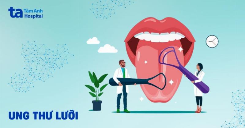 Dấu hiệu ung thư lưỡi giai đoạn đầu: Nhận biết sớm để bảo vệ nụ cười