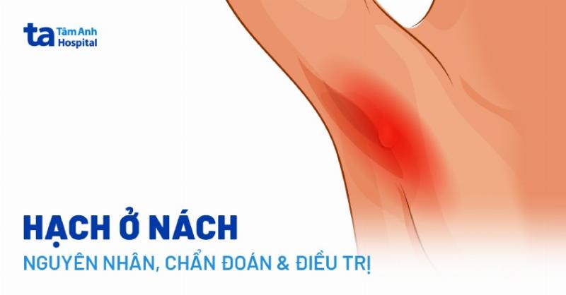 Tìm hiểu các nguyên nhân phổ biến và ít phổ biến gây nổi hạch ở háng bên phải nữ giới, giúp bạn có cái nhìn tổng quan về tình trạng này.