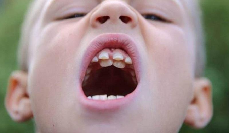 Răng Mọc Lẫy Hàm Dưới: Nguyên Nhân, Ảnh Hưởng Và Cách Khắc Phục Hiệu Quả