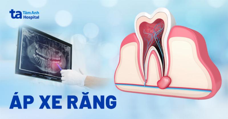 Áp Xe Răng Là Gì? Hiểu Rõ Để Bảo Vệ Nụ Cười Của Bạn