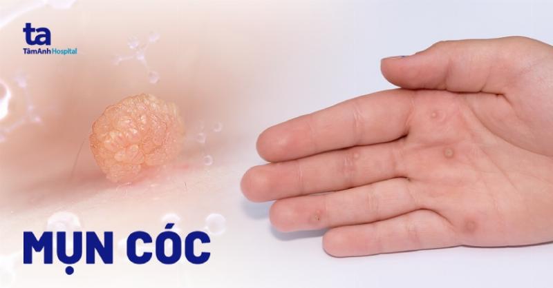 Hình ảnh minh họa giúp nhận biết đặc điểm và vị trí thường gặp của mụn cóc phẳng trên mặt