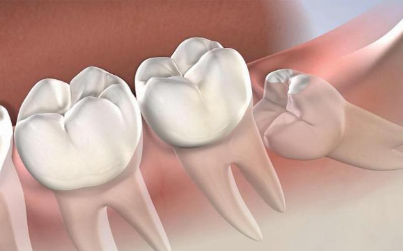 Hình minh họa so sánh thời gian tê giữa nhổ răng sâu và răng khôn