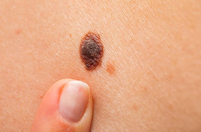 Những nốt ruồi nên xóa trên mặt nam giới: Góc nhìn chuyên gia và những điều cần biết