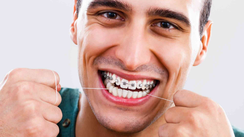 So sánh quá trình và kết quả niềng răng hô nhẹ ở trẻ em và người lớn