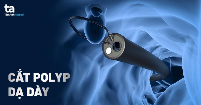 Hình ảnh minh họa quy trình nội soi cắt polyp dạ dày