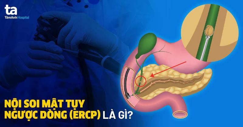 Hình minh họa quy trình nội soi mật tụy ngược dòng (ERCP) để lấy sỏi đường mật