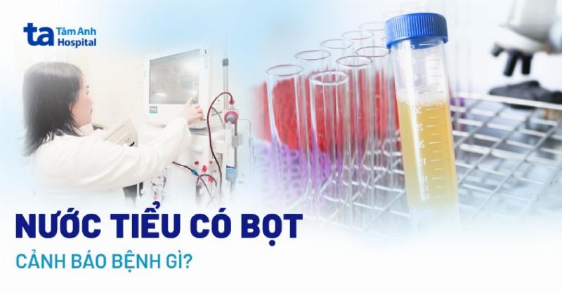 Hình ảnh nước tiểu có bọt dày đặc, lâu tan, gợi ý protein trong nước tiểu