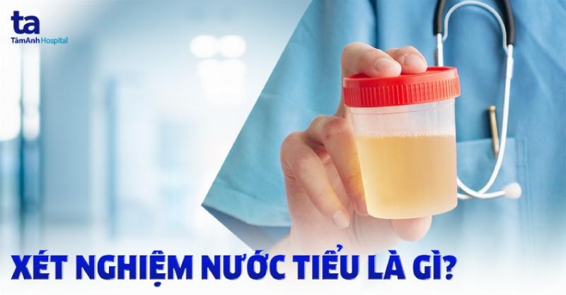 Minh họa lọ đựng mẫu nước tiểu để xét nghiệm