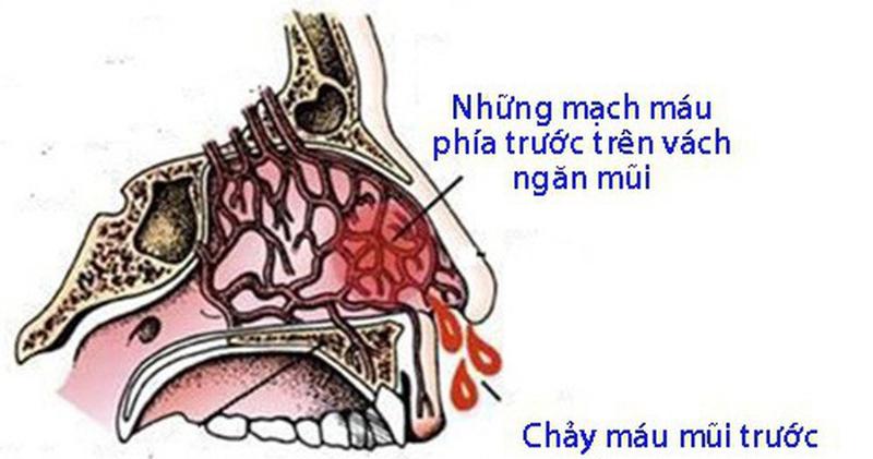 Sự khác biệt giữa chảy máu mũi trước và chảy máu mũi sau