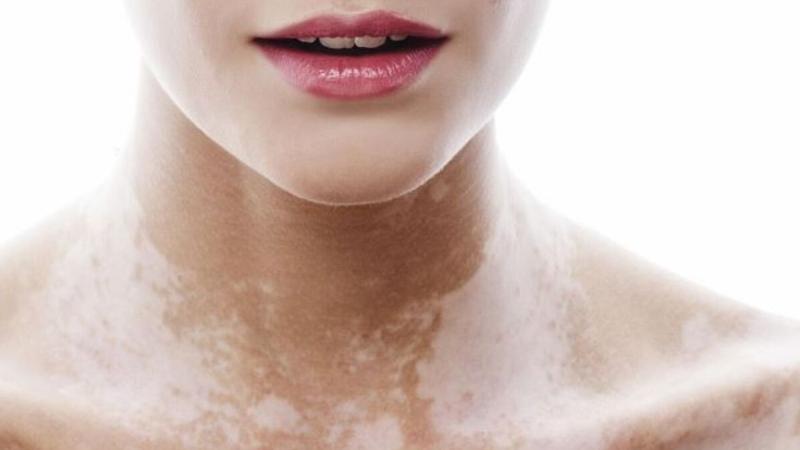 Sơ đồ so sánh các đặc điểm giúp phân biệt lang ben và bạch biến