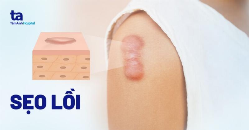 Hình ảnh minh họa sự khác biệt giữa sẹo lồi và sẹo phì đại trên da người