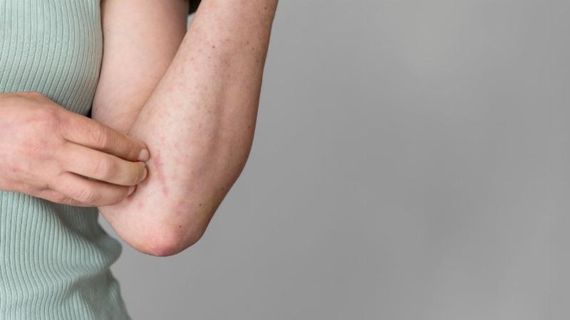 Ví dụ về phát ban nhẹ sau tiêm vắc xin sởi