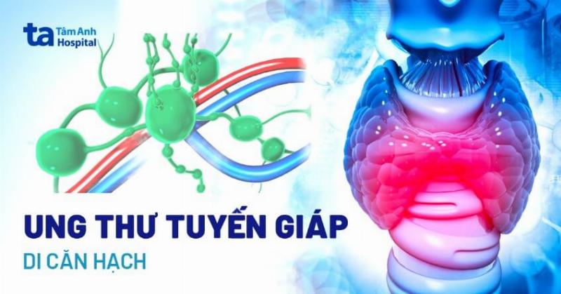 Cách làm nhỏ bướu cổ: Hiểu đúng, hành động khôn ngoan
