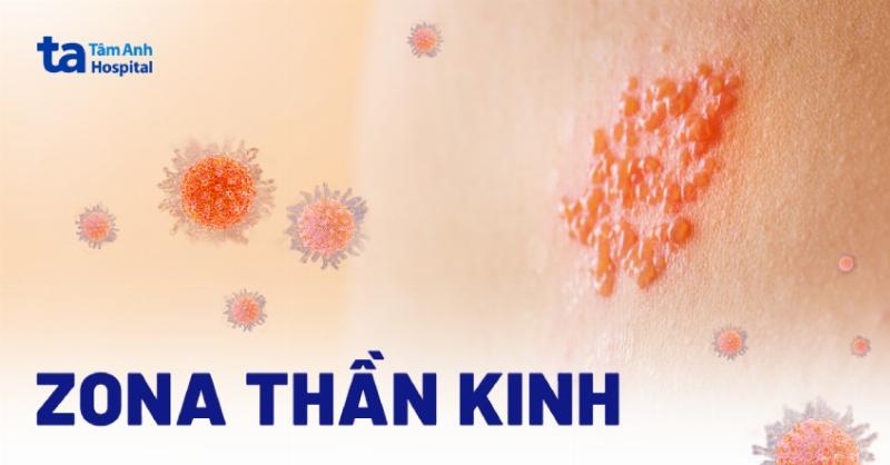 Hình ảnh minh họa các biện pháp phòng ngừa cảm giác da đau rát như bị bỏng