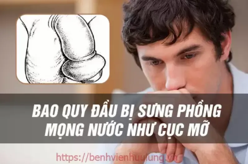 Bao Quy Đầu Bị Sưng Mọng Nước Ở Trẻ Nhỏ: Nỗi Lo Thầm Kín Của Bố Mẹ