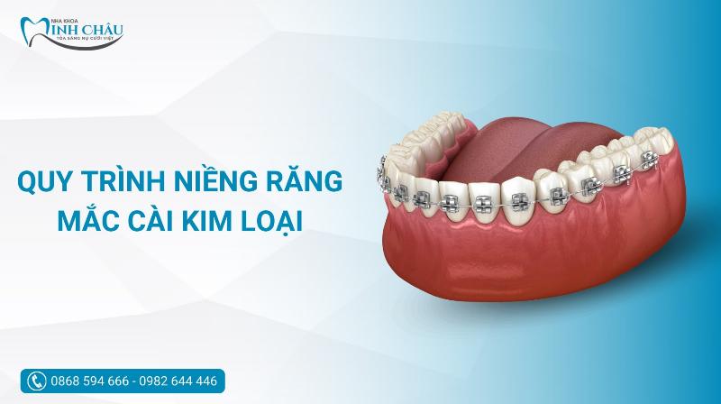 Niềng răng mắc cài kim loại có đau không? Câu trả lời chi tiết từ Nha khoa Bảo Anh