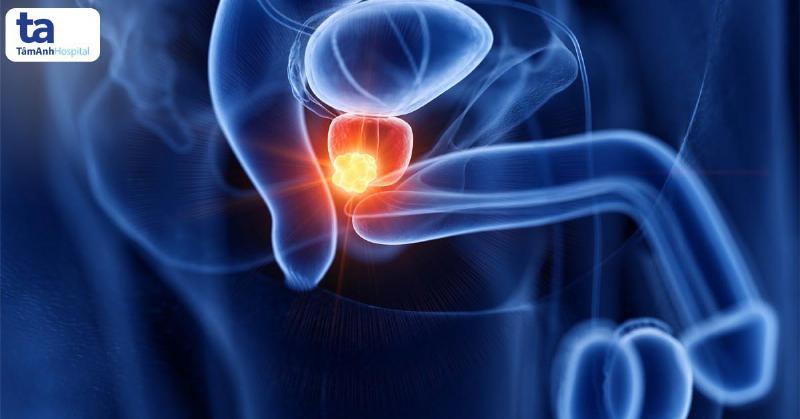 Định Lượng PSA Toàn Phần: Chỉ Số Sức Khỏe Tuyến Tiền Liệt Cần Hiểu Rõ