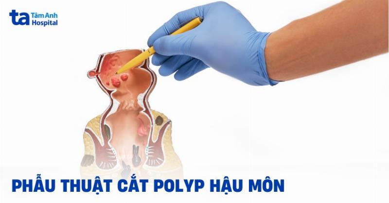 Sơ đồ quy trình chẩn đoán polyp hậu môn từ thăm khám ban đầu đến các kỹ thuật chuyên sâu.