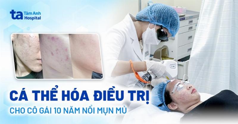 Mụn Mủ Có Nên Nặn Không? Lời Khuyên Từ Chuyên Gia