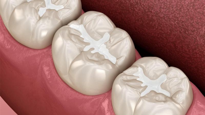 Răng trẻ bị sâu cần được trám