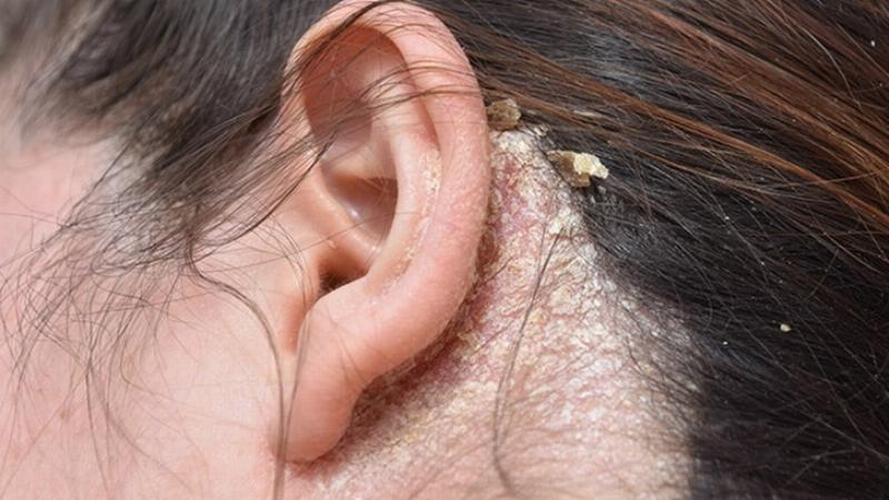 Dầu Gội Trị Gàu Tốt Nhất Cho Nữ: Chìa Khóa Tóc Khỏe, Tự Tin Tỏa Sáng