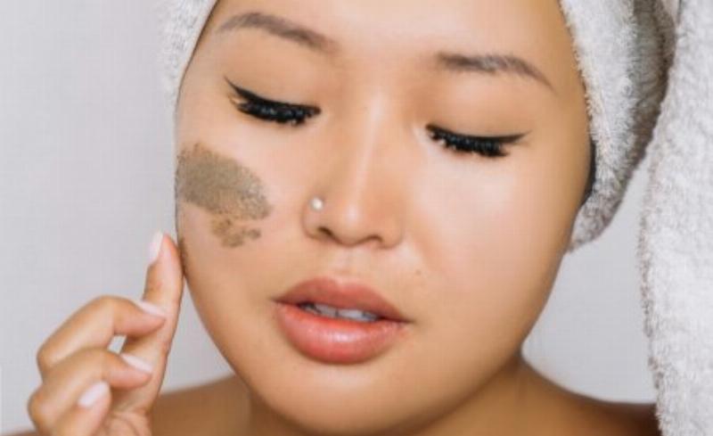 Sự liên hệ giữa sẹo đáy nhọn, lỗ chân lông to và mụn viêm