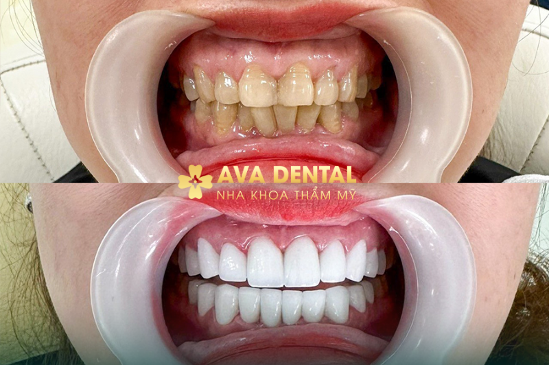 So sánh chi phí ước tính các phương pháp niềng răng phổ biến năm 2024