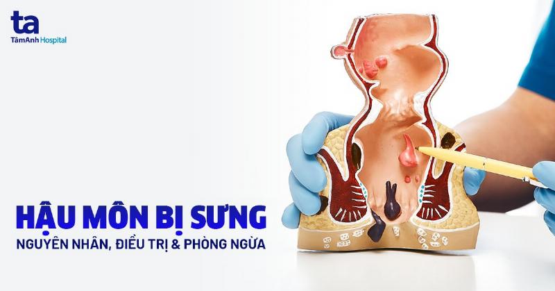 So sánh lỗ rò hậu môn với trĩ và nứt kẽ
