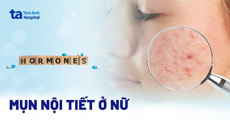 Stress mãn tính có thể làm trầm trọng thêm tình trạng mụn nội tiết ở vùng cằm do ảnh hưởng đến hormone cortisol