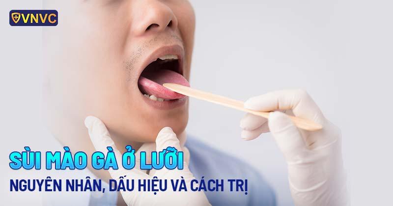 Sùi Mào Gà Ở Lưỡi: Nhận Biết, Chẩn Đoán Và Cách Đối Phó