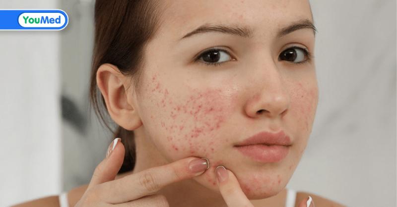 Tại Sao Mặt Nổi Mụn? Hé Lộ Những Nguyên Nhân Bất Ngờ Bạn Cần Biết