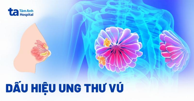 Nhận Biết Các Dấu Hiệu Ung Thư Vú Sớm: Hướng Dẫn Chi Tiết Từ Góc Nhìn Chuyên Gia