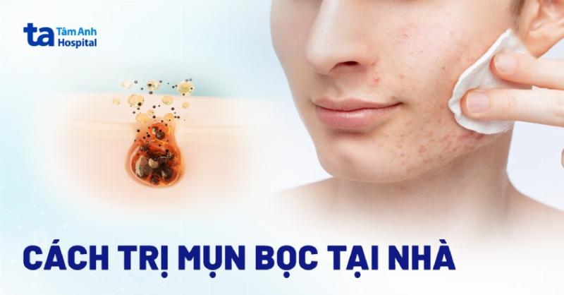 Các loại thực phẩm nên hạn chế khi bị mụn trứng cá, bao gồm mụn bọc không đầu