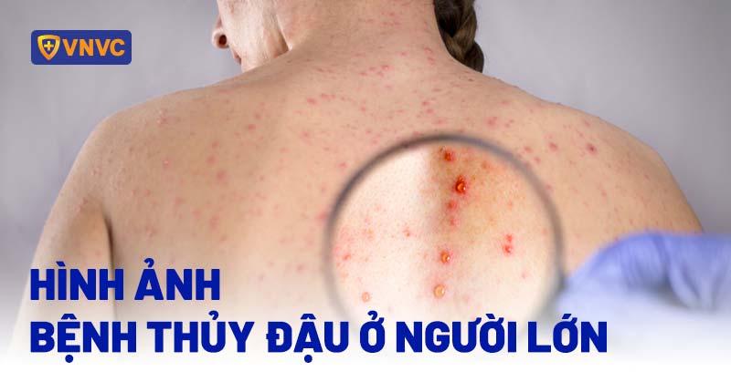 Hình ảnh cận cảnh nốt mụn nước đặc trưng của bệnh thủy đậu ở người lớn, có dịch trong