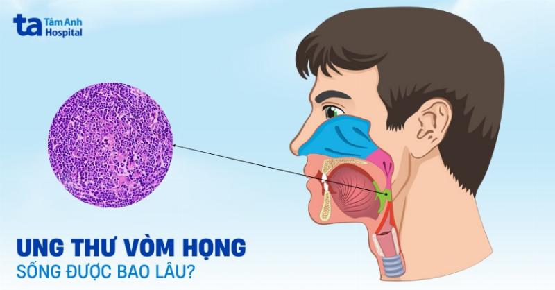 Bieu do ti le song sot sau nam cua ung thu vom hong theo tung giai doan